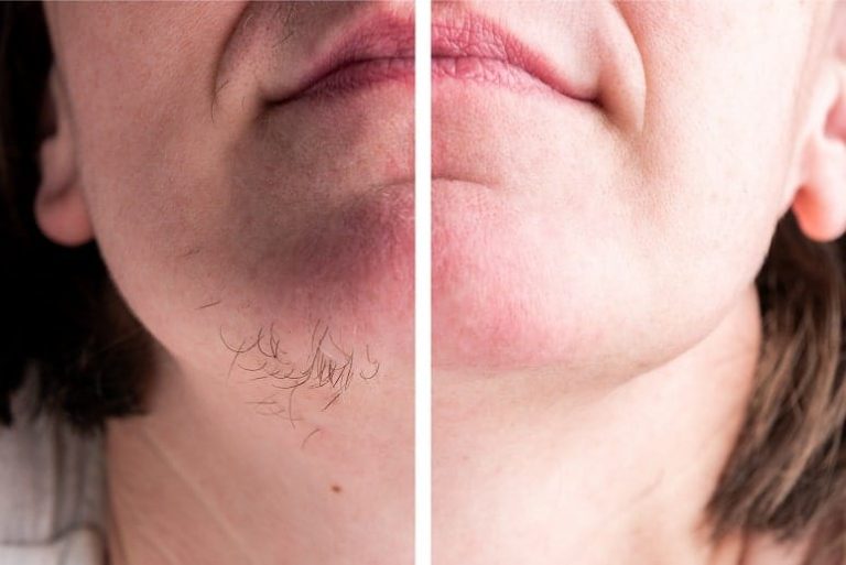 facial laser hair removal before and after min
