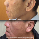 Microneedling session  